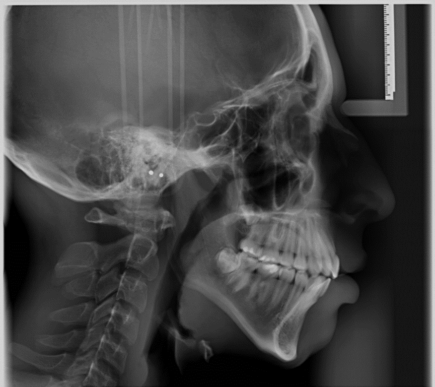 Telerradiografia lateral de cráneo