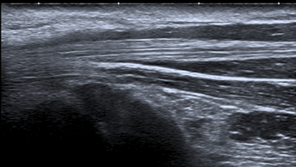 Ejemplo de imagen ecográfica de unos tendones.